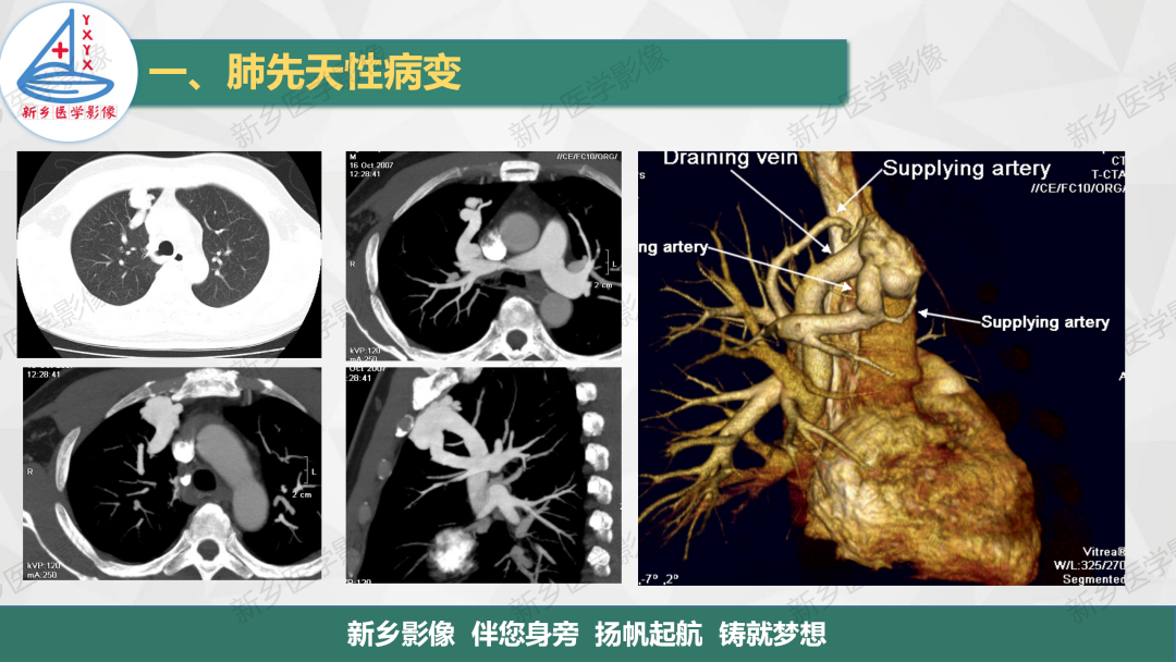 影像PPT - 【PPT】医学影像诊断学教材解读—肺部病变-12