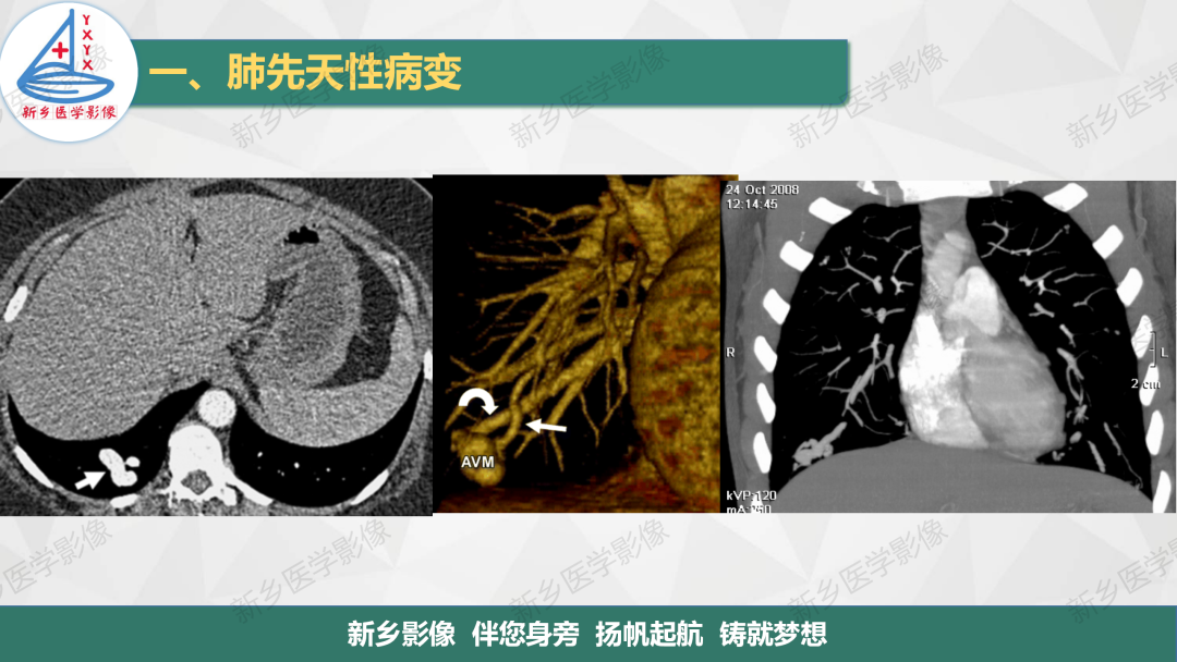 影像PPT - 【PPT】医学影像诊断学教材解读—肺部病变-13