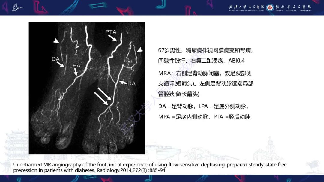 影像PPT - 【PPT】糖尿病足影像诊断-5