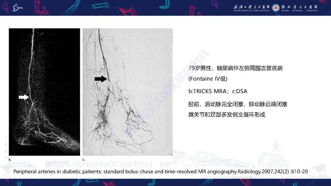 影像PPT - 【PPT】糖尿病足影像诊断-6