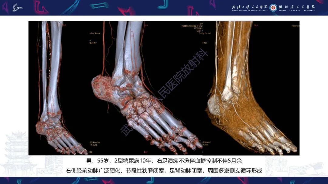 影像PPT - 【PPT】糖尿病足影像诊断-7