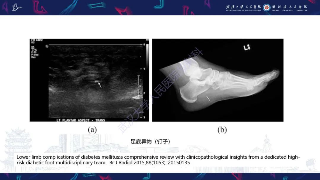 影像PPT - 【PPT】糖尿病足影像诊断-12