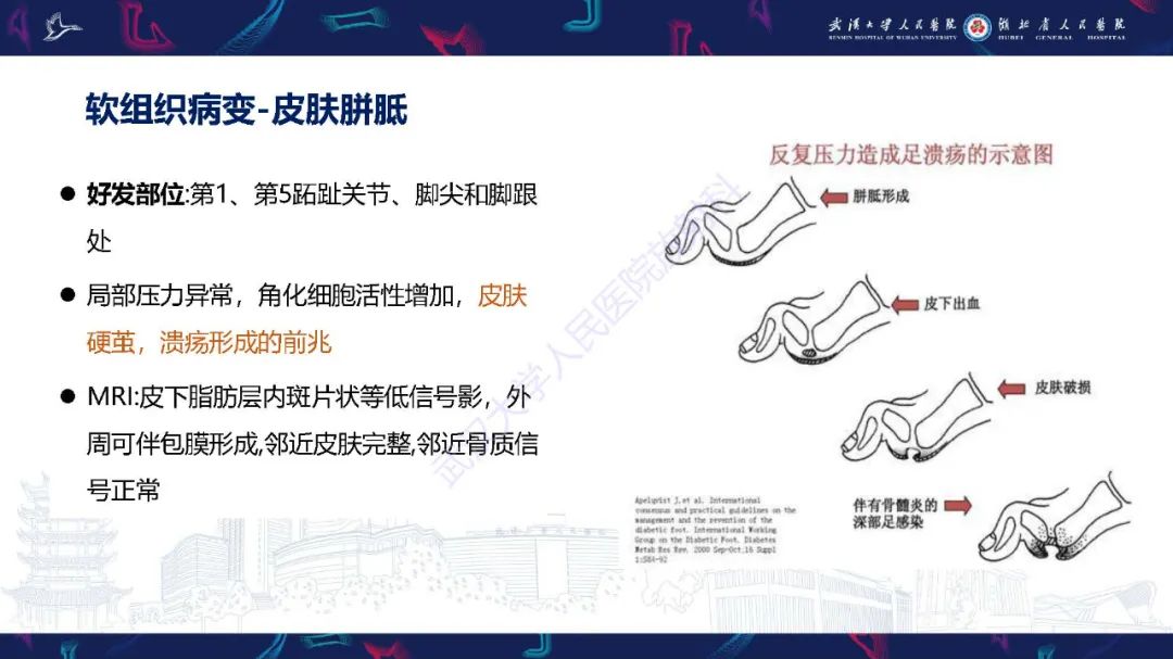 影像PPT - 【PPT】糖尿病足影像诊断-13