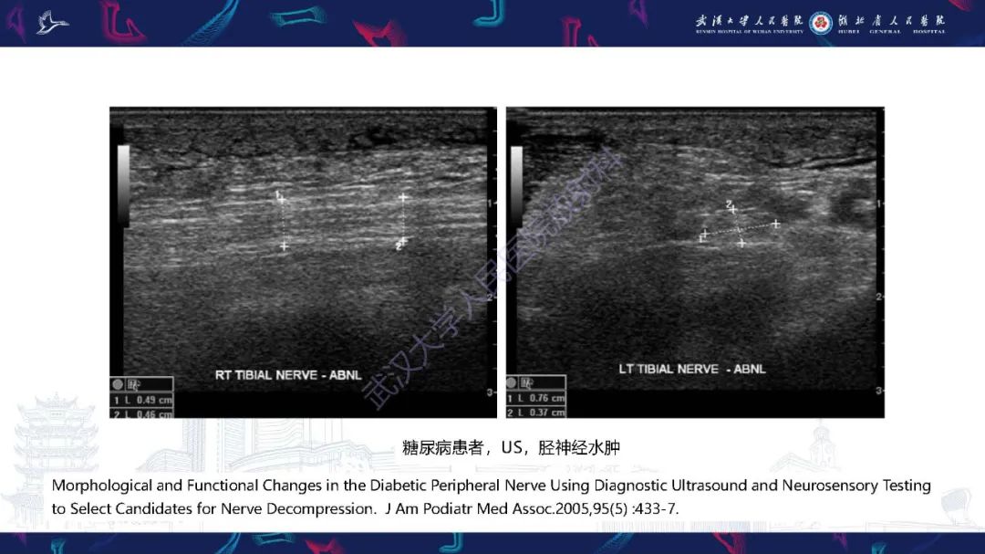 影像PPT - 【PPT】糖尿病足影像诊断-11