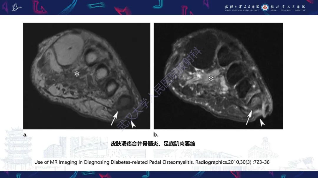 影像PPT - 【PPT】糖尿病足影像诊断-17