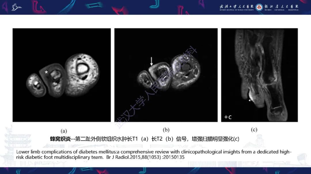 影像PPT - 【PPT】糖尿病足影像诊断-19