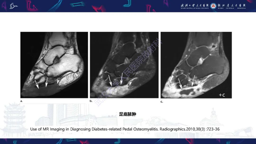 影像PPT - 【PPT】糖尿病足影像诊断-20