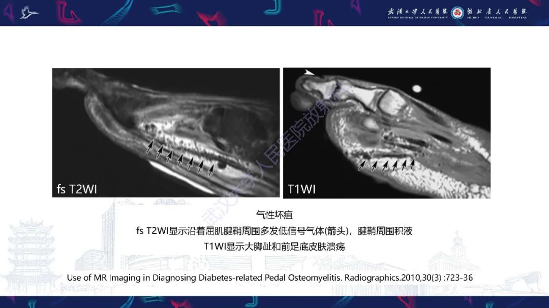 影像PPT - 【PPT】糖尿病足影像诊断-21