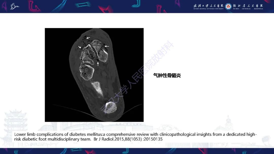 影像PPT - 【PPT】糖尿病足影像诊断-22