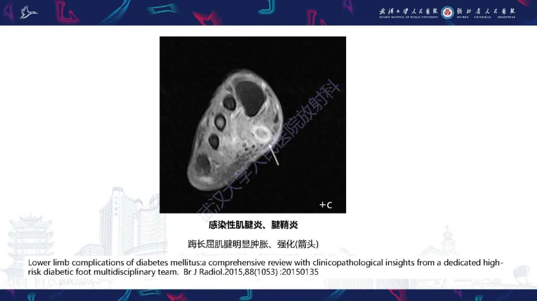 影像PPT - 【PPT】糖尿病足影像诊断-24