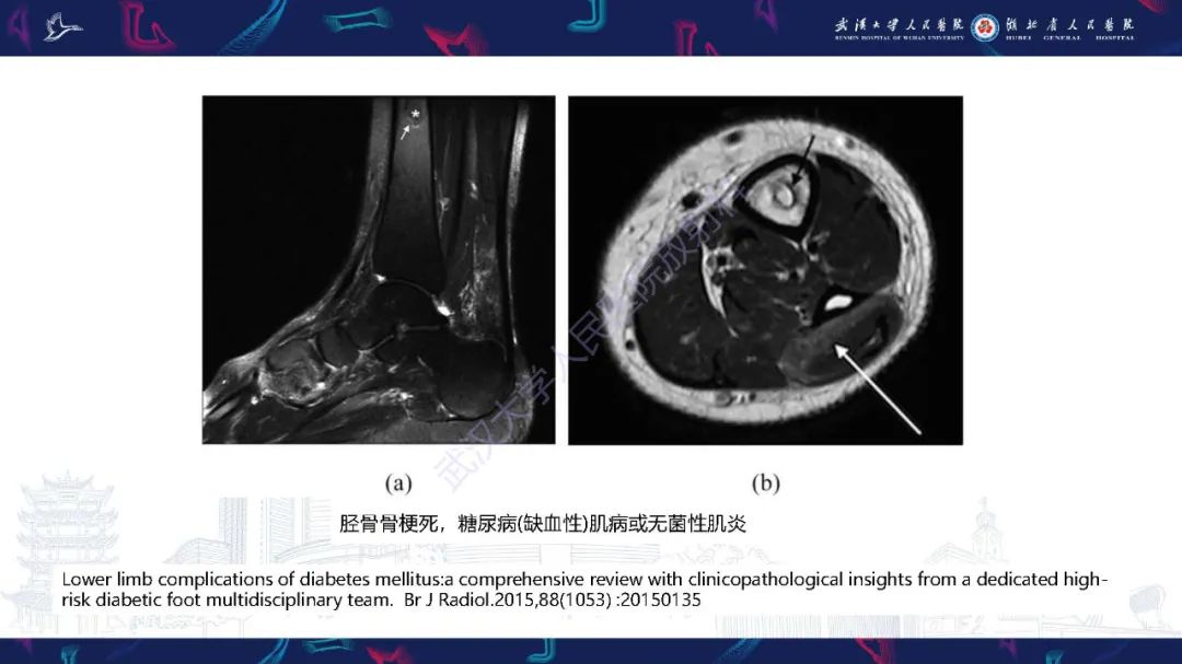影像PPT - 【PPT】糖尿病足影像诊断-25