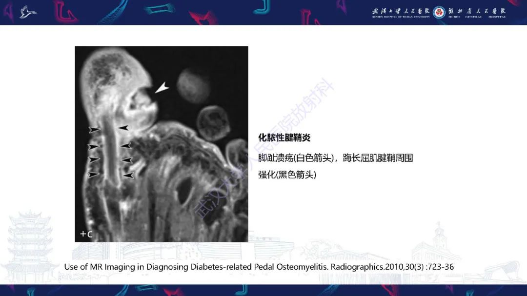 影像PPT - 【PPT】糖尿病足影像诊断-26