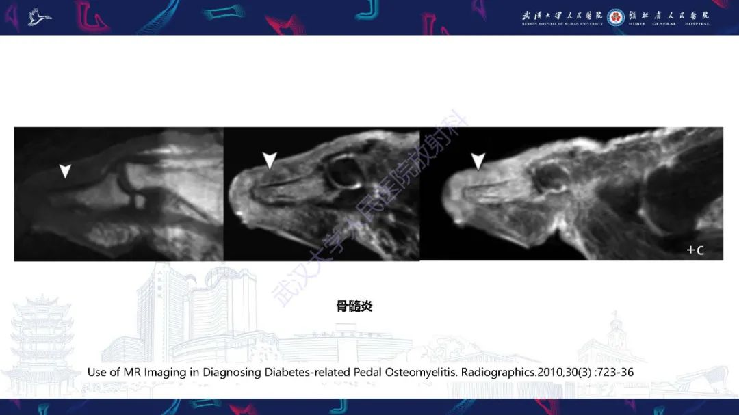 影像PPT - 【PPT】糖尿病足影像诊断-28