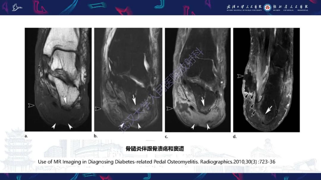 影像PPT - 【PPT】糖尿病足影像诊断-29