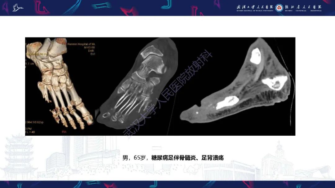 影像PPT - 【PPT】糖尿病足影像诊断-30