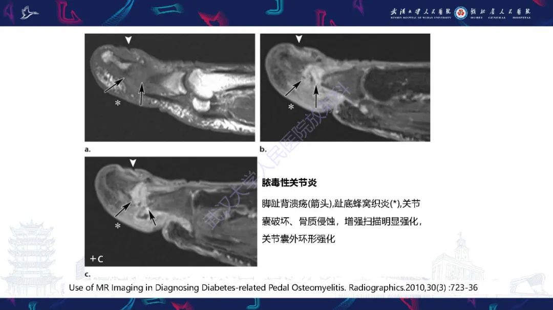 影像PPT - 【PPT】糖尿病足影像诊断-32