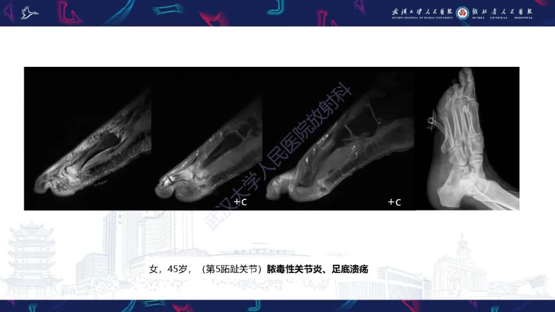 影像PPT - 【PPT】糖尿病足影像诊断-33