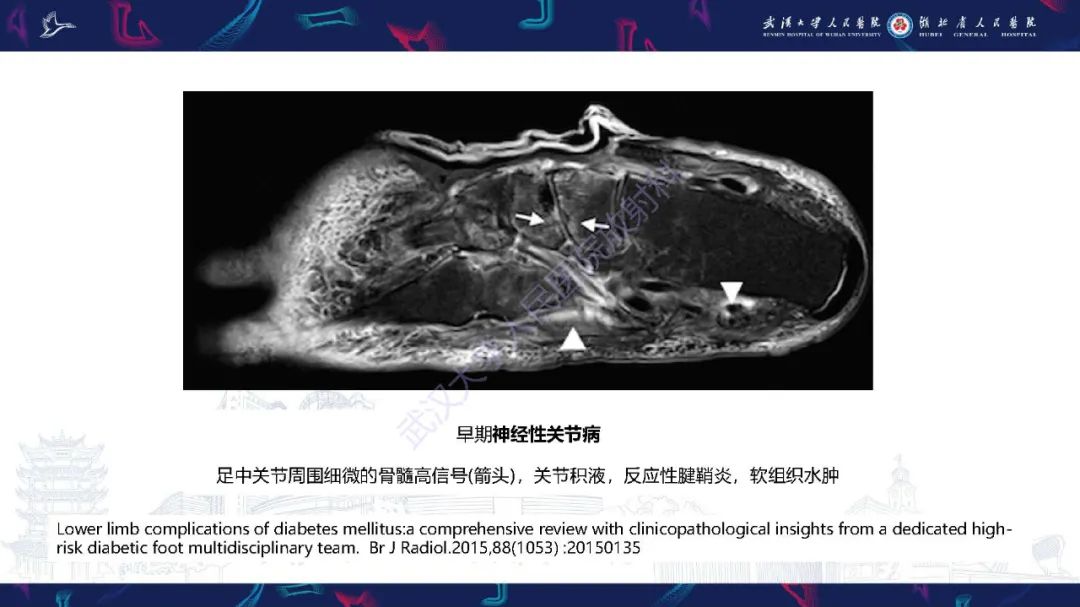 影像PPT - 【PPT】糖尿病足影像诊断-35