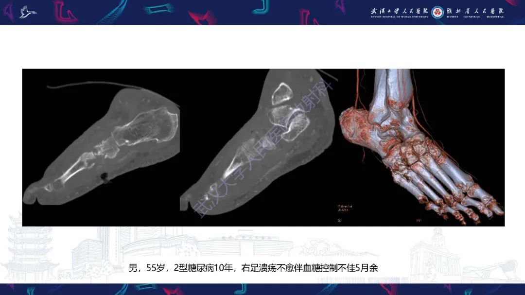 影像PPT - 【PPT】糖尿病足影像诊断-36