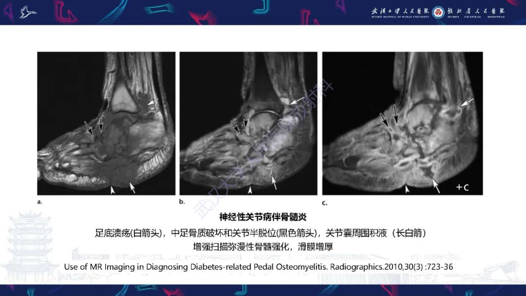影像PPT - 【PPT】糖尿病足影像诊断-37