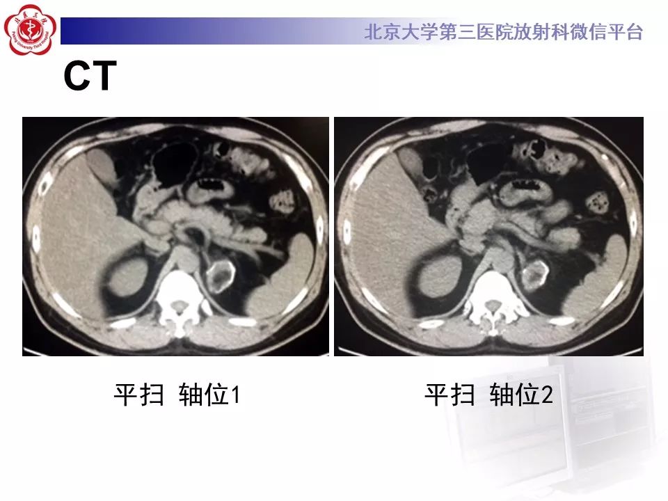 影像PPT - 【PPT】肾上腺髓样脂肪瘤-5