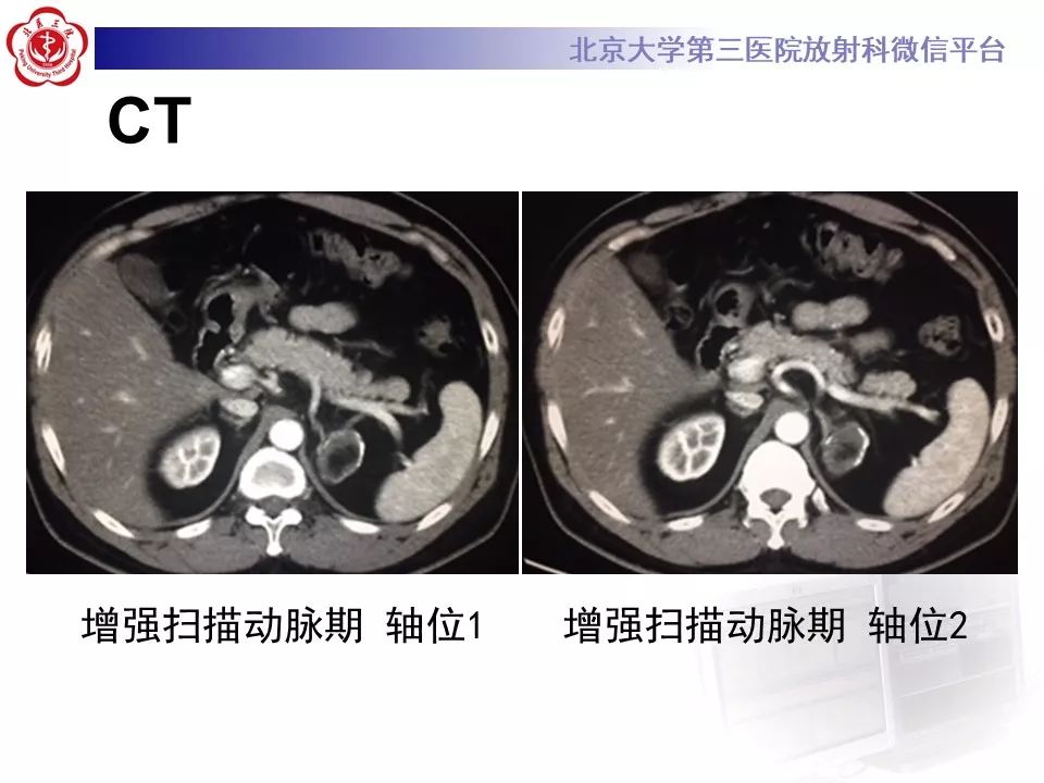 影像PPT - 【PPT】肾上腺髓样脂肪瘤-6