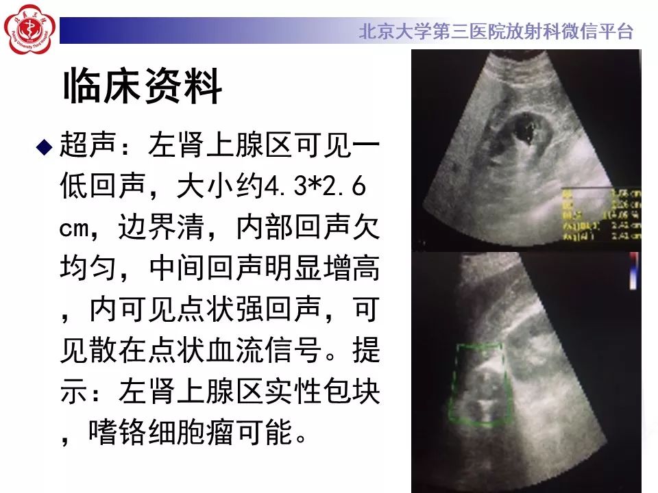 影像PPT - 【PPT】肾上腺髓样脂肪瘤-4