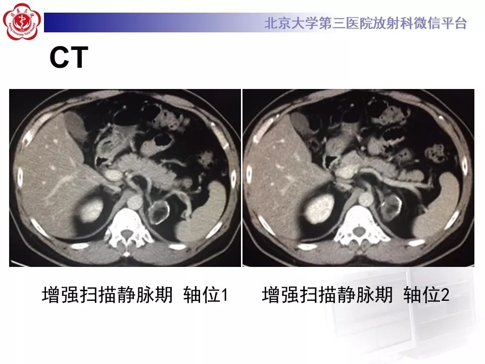 影像PPT - 【PPT】肾上腺髓样脂肪瘤-7