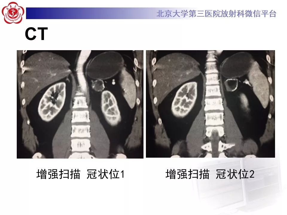 影像PPT - 【PPT】肾上腺髓样脂肪瘤-8