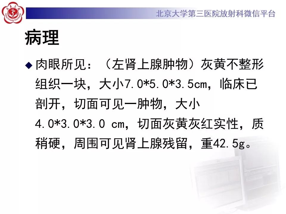 影像PPT - 【PPT】肾上腺髓样脂肪瘤-12