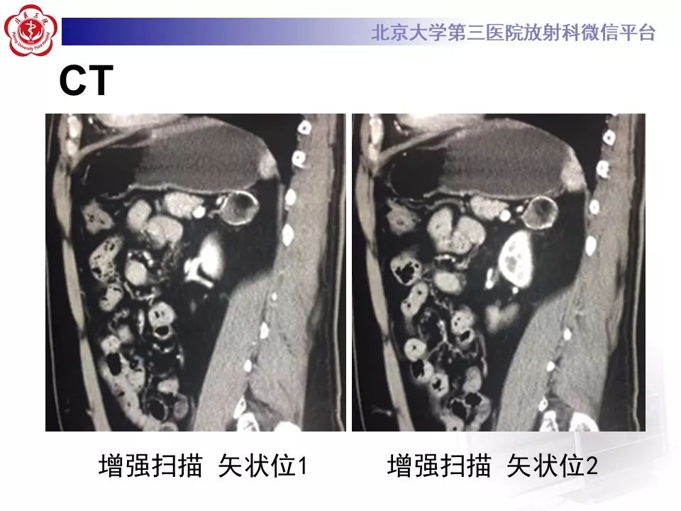 影像PPT - 【PPT】肾上腺髓样脂肪瘤-9