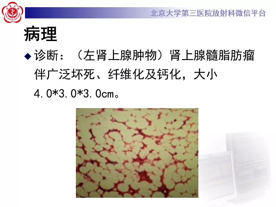 影像PPT - 【PPT】肾上腺髓样脂肪瘤-13