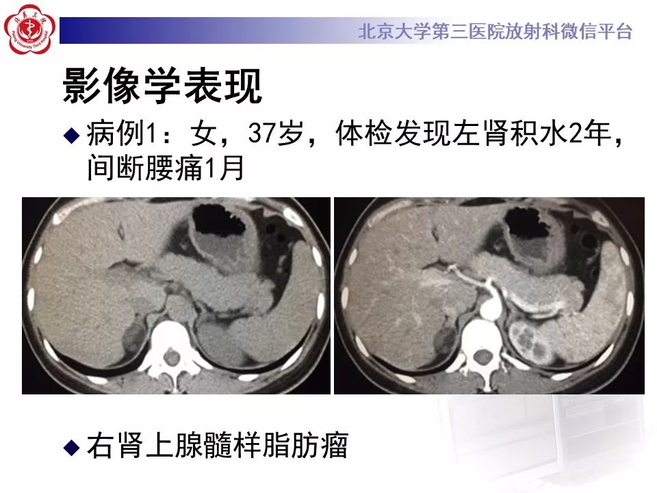 影像PPT - 【PPT】肾上腺髓样脂肪瘤-23