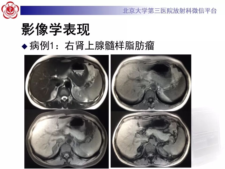 影像PPT - 【PPT】肾上腺髓样脂肪瘤-24