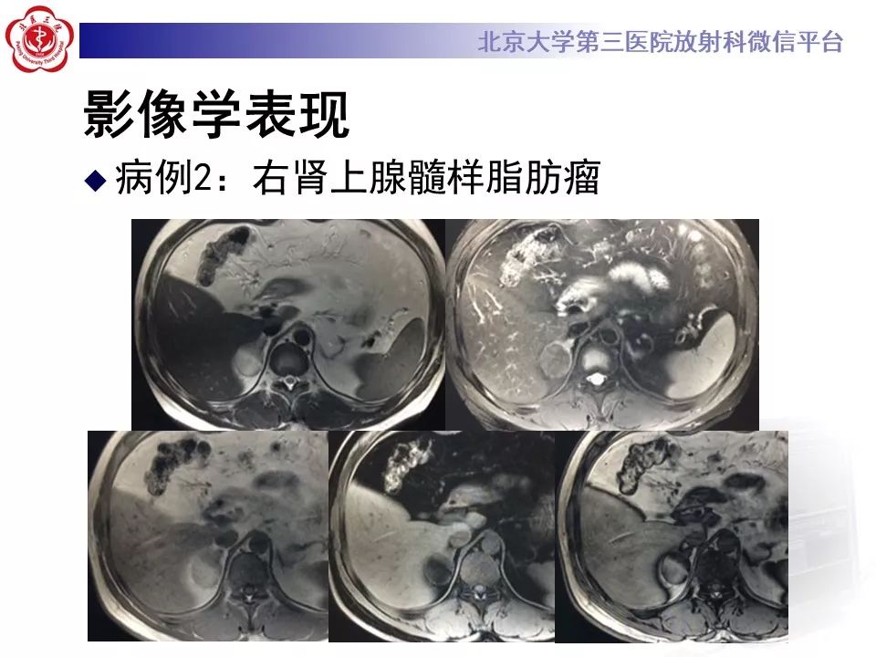 影像PPT - 【PPT】肾上腺髓样脂肪瘤-26