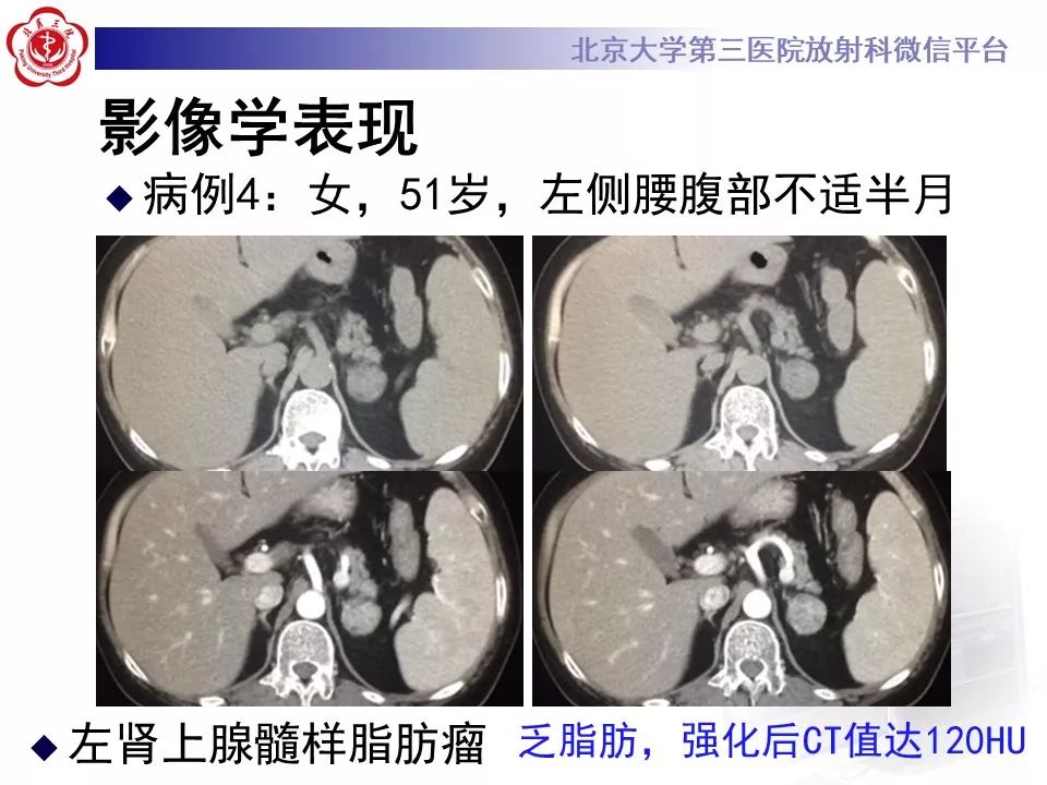 影像PPT - 【PPT】肾上腺髓样脂肪瘤-28