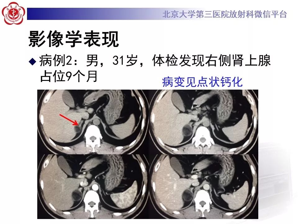 影像PPT - 【PPT】肾上腺髓样脂肪瘤-25