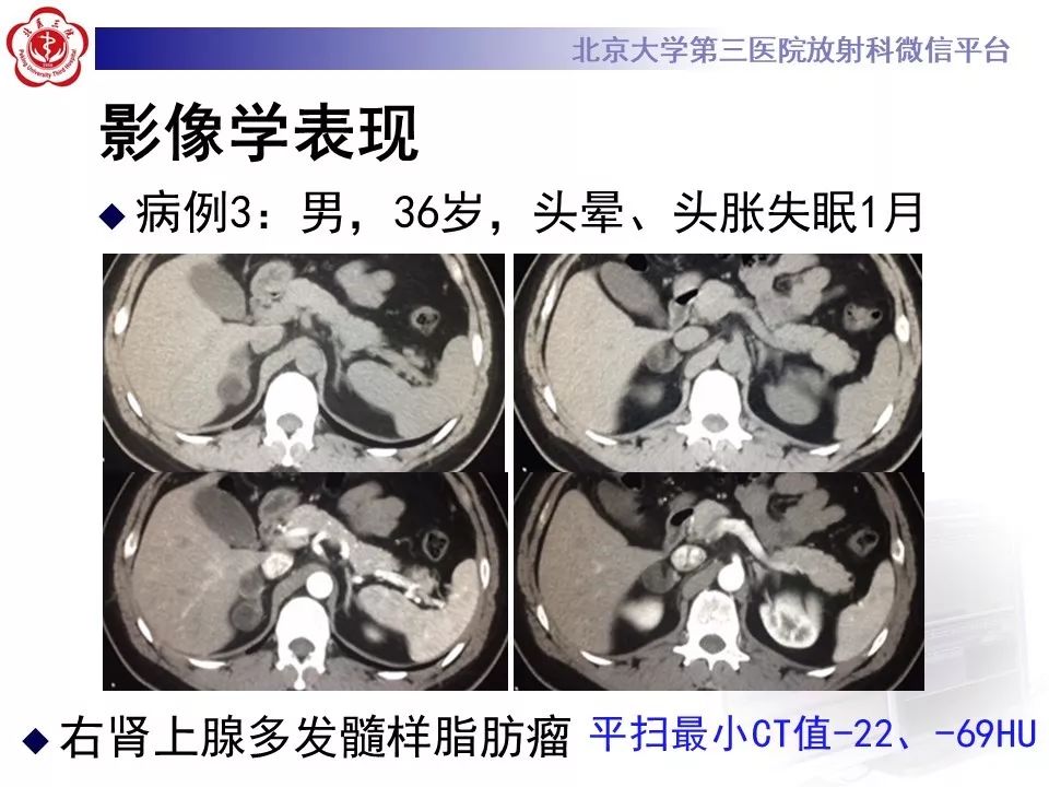 影像PPT - 【PPT】肾上腺髓样脂肪瘤-27