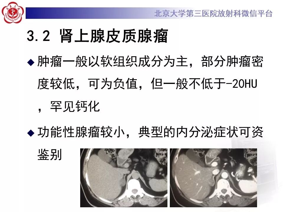 影像PPT - 【PPT】肾上腺髓样脂肪瘤-31