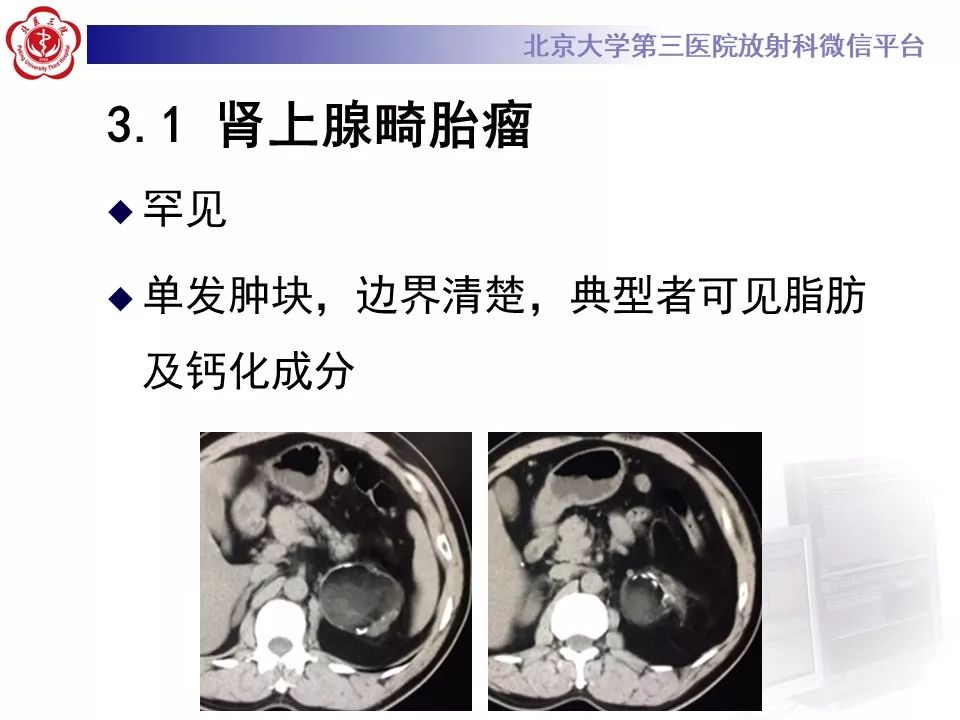影像PPT - 【PPT】肾上腺髓样脂肪瘤-30