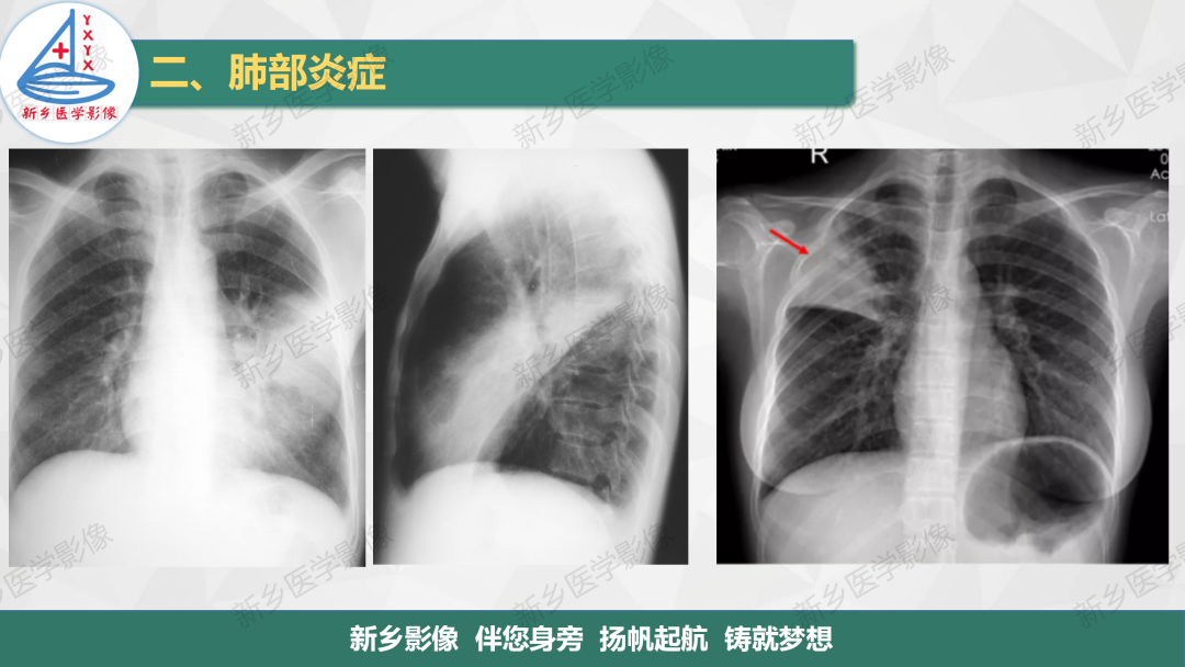 影像PPT - 【PPT】医学影像诊断学教材解读—肺部病变2-5