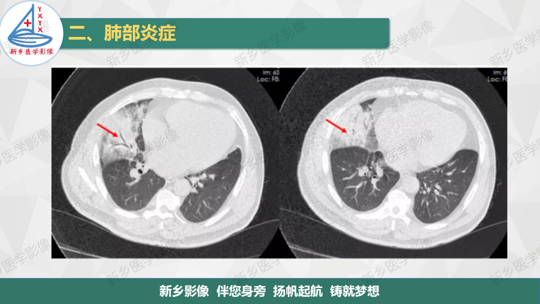 影像PPT - 【PPT】医学影像诊断学教材解读—肺部病变2-6