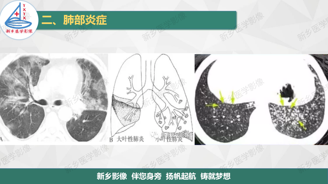 影像PPT - 【PPT】医学影像诊断学教材解读—肺部病变2-9