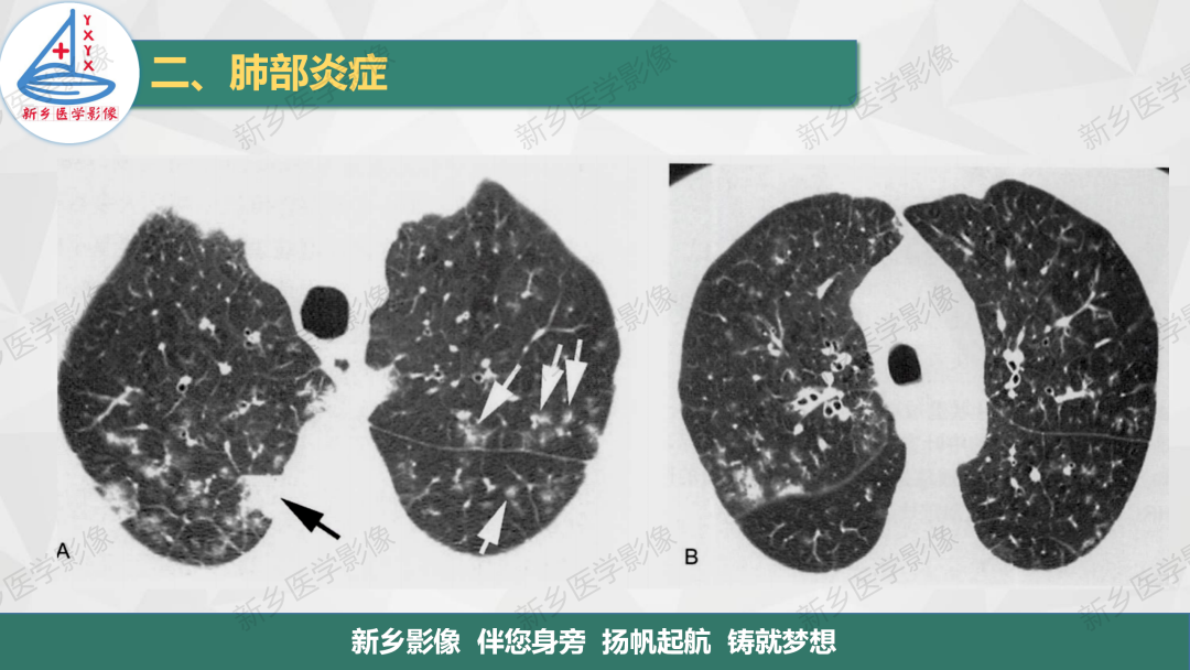 影像PPT - 【PPT】医学影像诊断学教材解读—肺部病变2-10