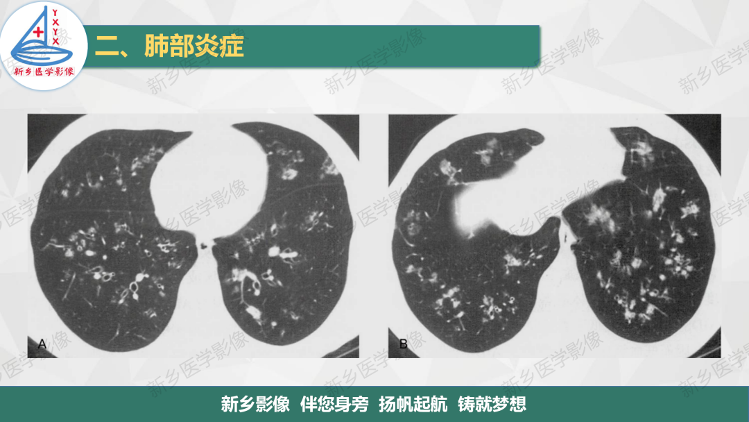 影像PPT - 【PPT】医学影像诊断学教材解读—肺部病变2-11