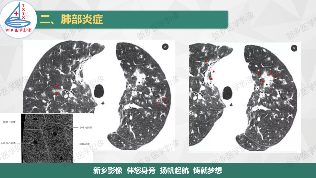 影像PPT - 【PPT】医学影像诊断学教材解读—肺部病变2-15