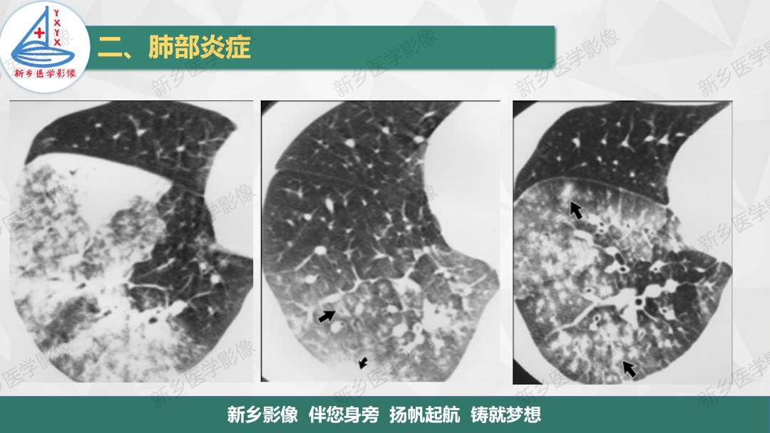 影像PPT - 【PPT】医学影像诊断学教材解读—肺部病变2-16
