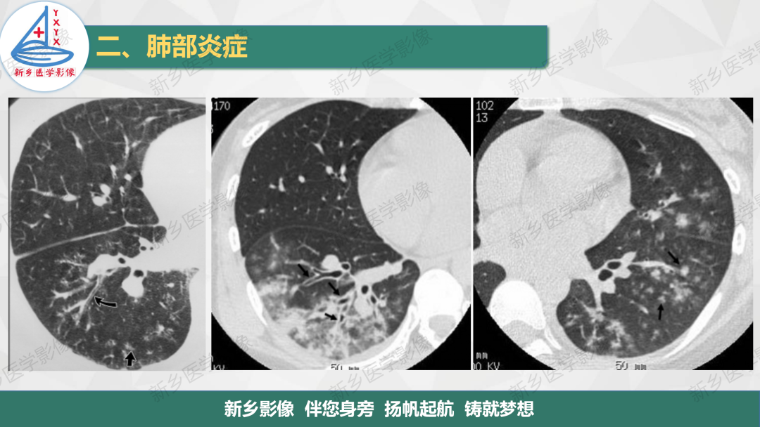 影像PPT - 【PPT】医学影像诊断学教材解读—肺部病变2-17
