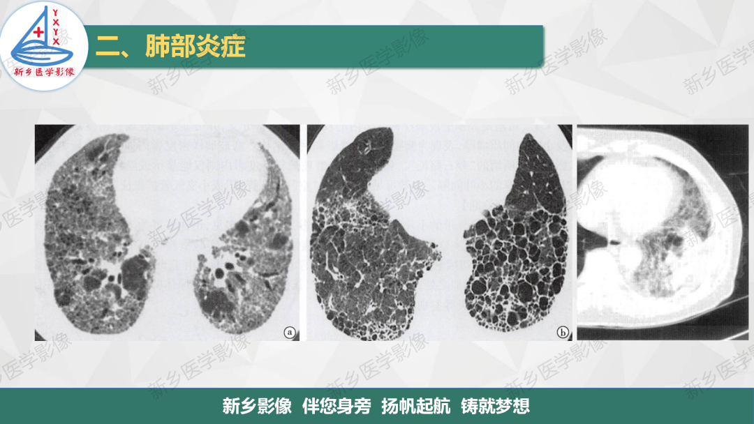影像PPT - 【PPT】医学影像诊断学教材解读—肺部病变2-21