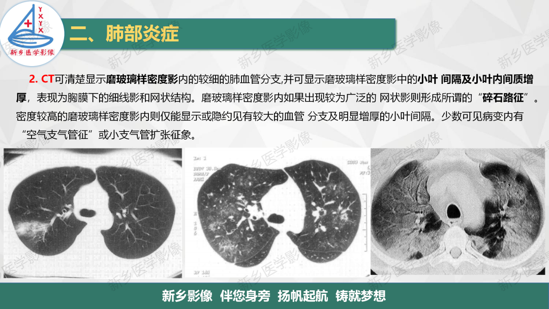 影像PPT - 【PPT】医学影像诊断学教材解读—肺部病变2-24
